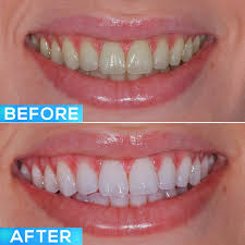 Home Teeth Whitening Products
